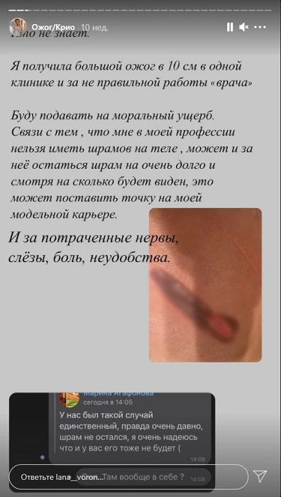 ожог.jpg